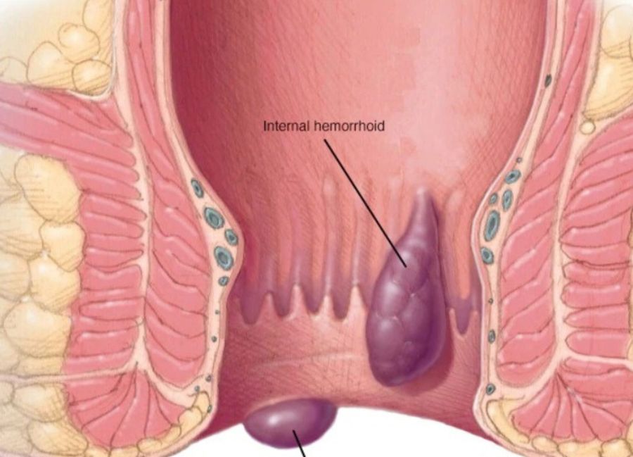 Rectal